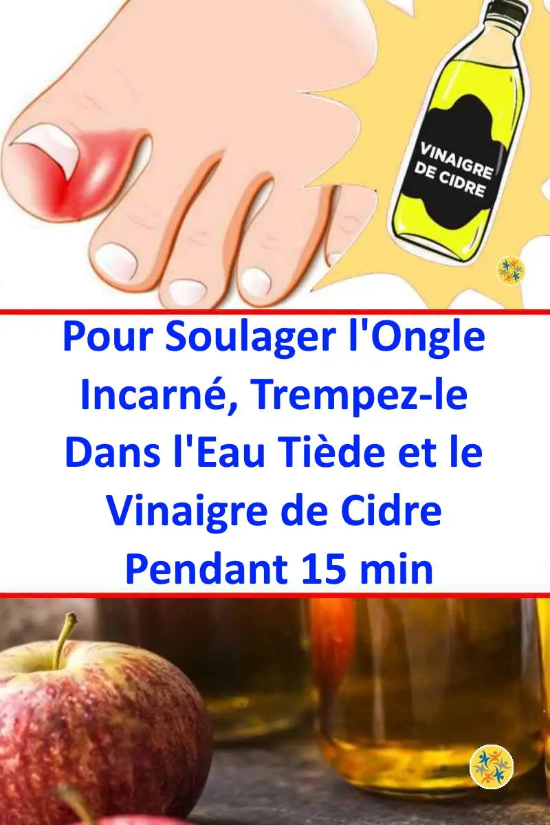 Entlasten Sie eingewachsene Zehennägel mit Apfelessig