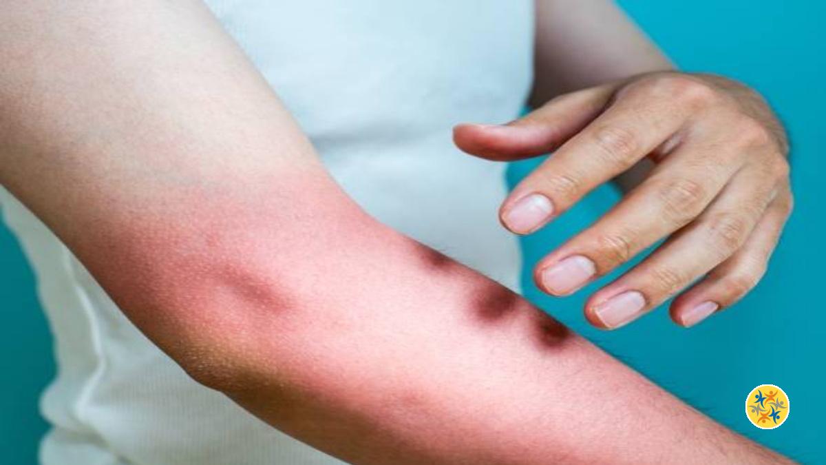 6 Solutions pour Apaiser les Rougeurs et Calmer les Brûlures Rapidement