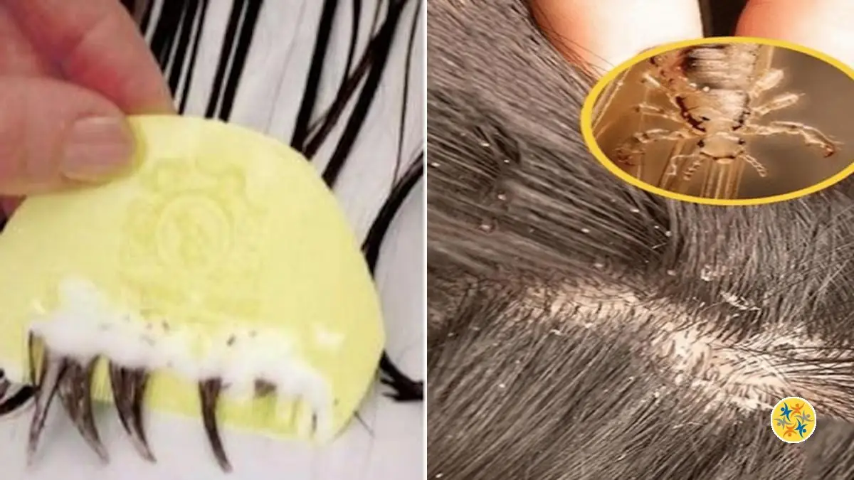 Dites Adieu aux Poux grâce à ce Remède 100 % Naturel