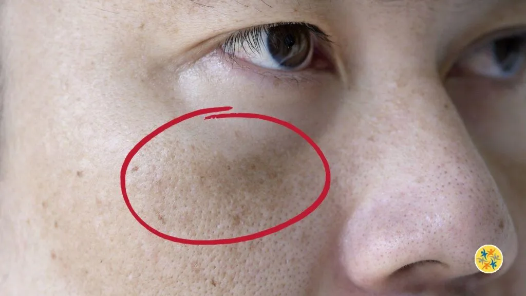 6 Solutions naturelles pour combattre les taches brunes