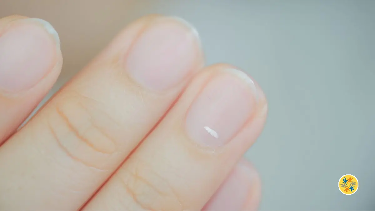 Que Signifient les Taches Blanches sur les Ongles ?