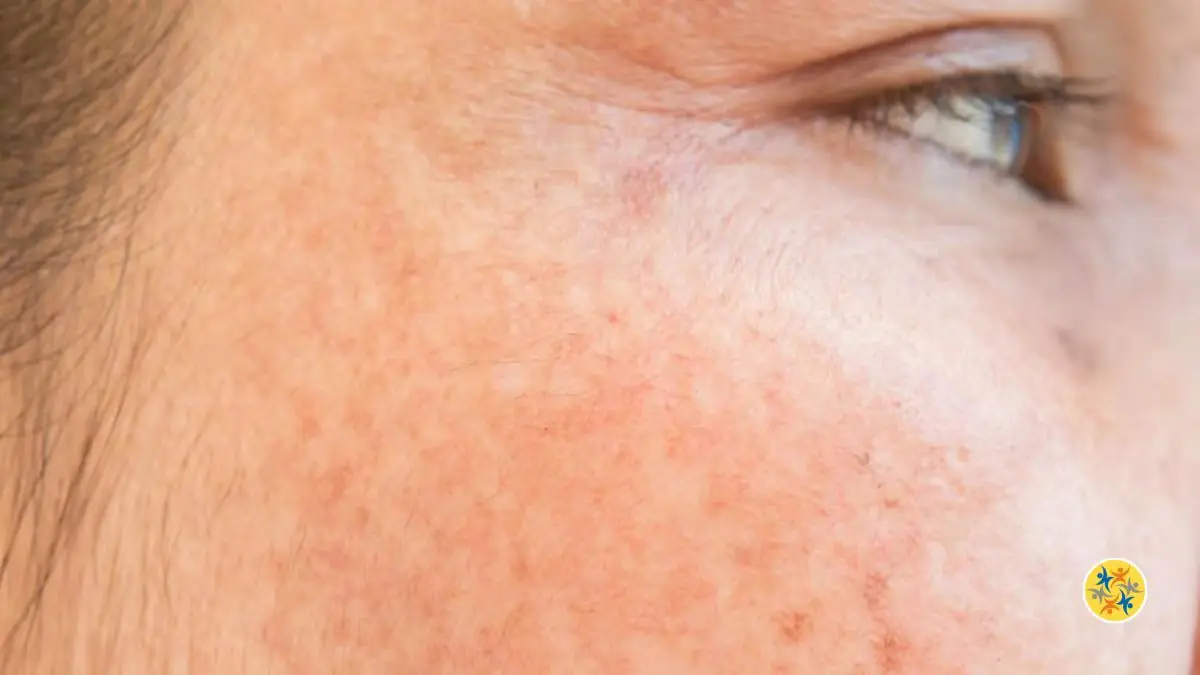 Les Taches Brunes Comment y Remédier au Naturel?