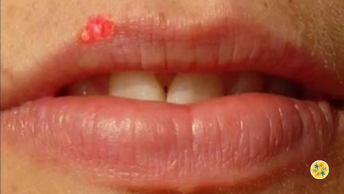 Comment Faire Partir un Bouton de Fièvre Gênant?