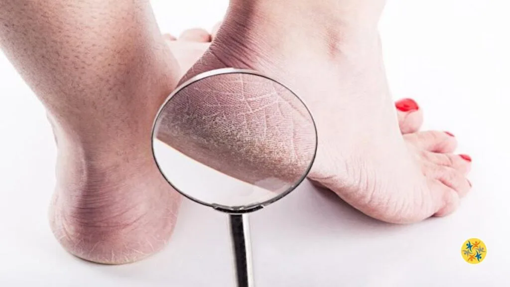 Améliorer l'état des callosités et de la peau sèche au niveau des talons