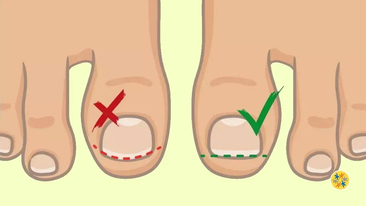 Comment se Couper les Ongles Sans Avoir d’Ongle Incarné