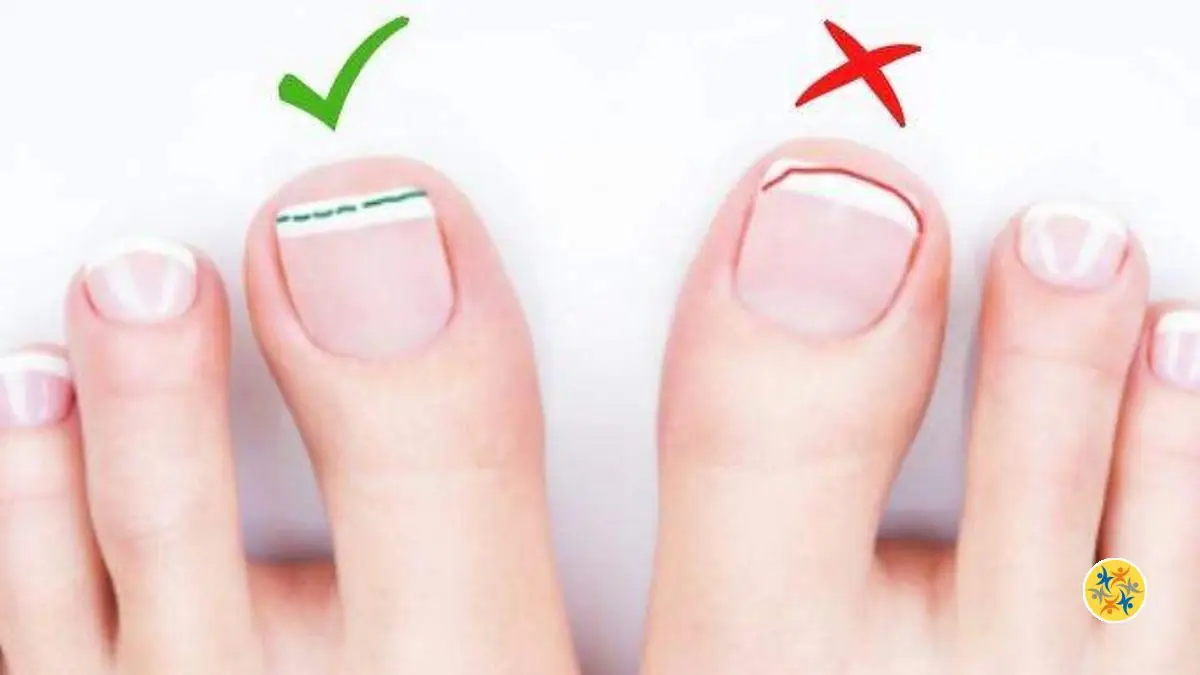 Le Truc Pour Prévenir l’Ongle Incarné Suite à la Coupe des Ongles
